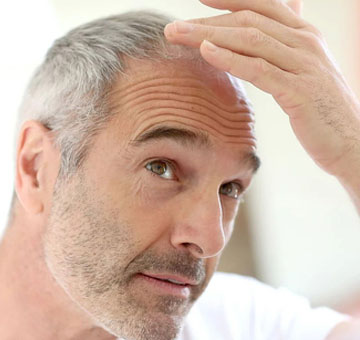 Best Hair Transplant in Kolkata
