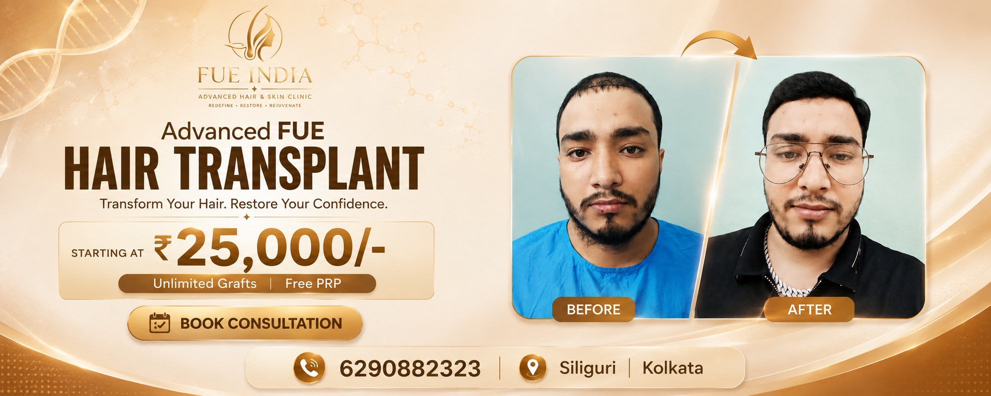 Hair transplant in 25000 Rs
